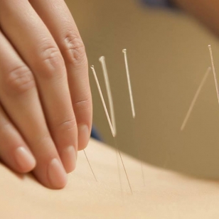 Acupuntura