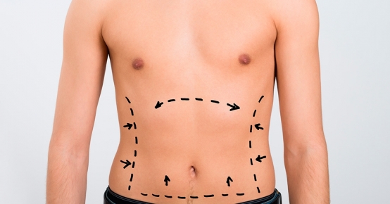 Lipoaspiração | Lipoenxertia | Lipoescultura