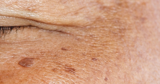 Melasma