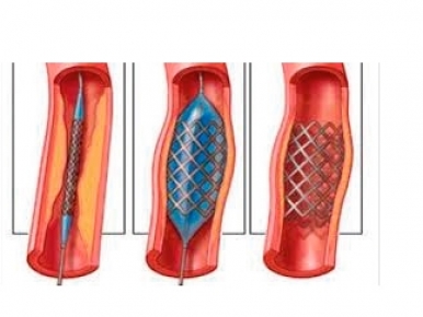 Cirurgia Vascular e seus avanços