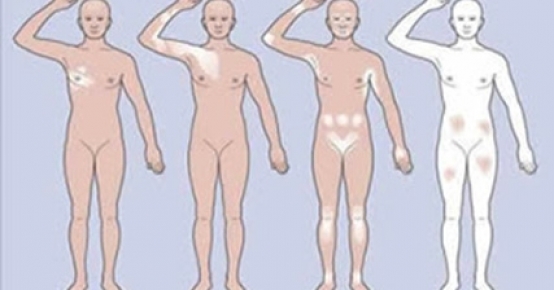 Vitiligo 